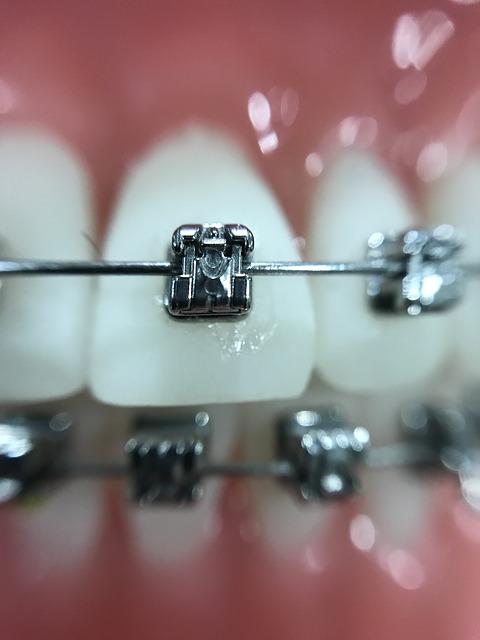 Fiksni zobni aparati so pogosto najbolj prepričljivi